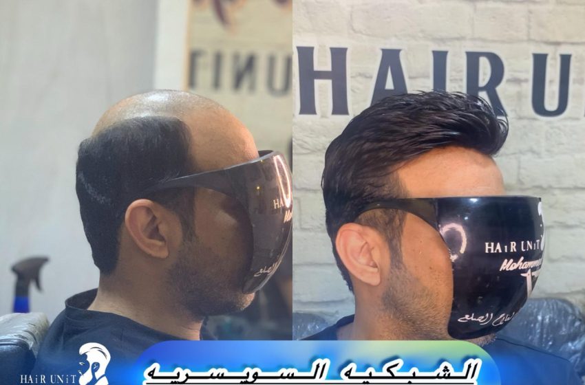  مركز تجميل محمد جمال – ريادة في علاج الصلع بتركيب الشبكية الأعلى واقعية واحترافية